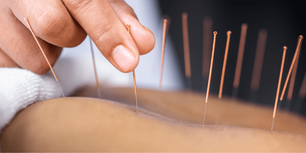 A person getting an acupuncture treatment.